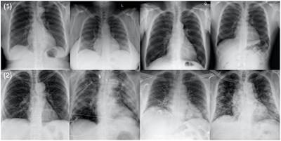 COVID-Net CXR-2: An Enhanced Deep Convolutional Neural Network Design for Detection of COVID-19 Cases From Chest X-ray Images